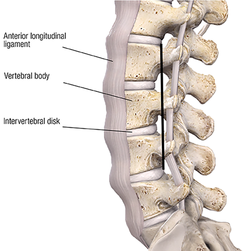 The intervertebral disk and vertebral bodies manage the large compressive loads of the spine. The majority of upper body weight is transmitted to the skeleton of the lower body through the lumbar spine. That is why the intervertebral disks and vertebral bodies are largest in the lumbar region. The lumbar motion segments must carry that compressive load while still being mobile. The third component, the anterior longitudinal ligament, limits spinal extension and helps maintain the structural integrity of the intervertebral disk.