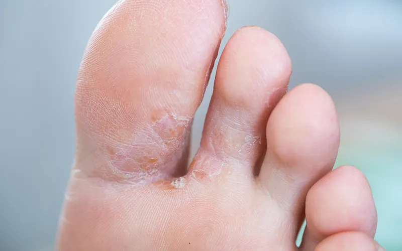 JA_19_Mycoses3 JA_19_Mycoses3