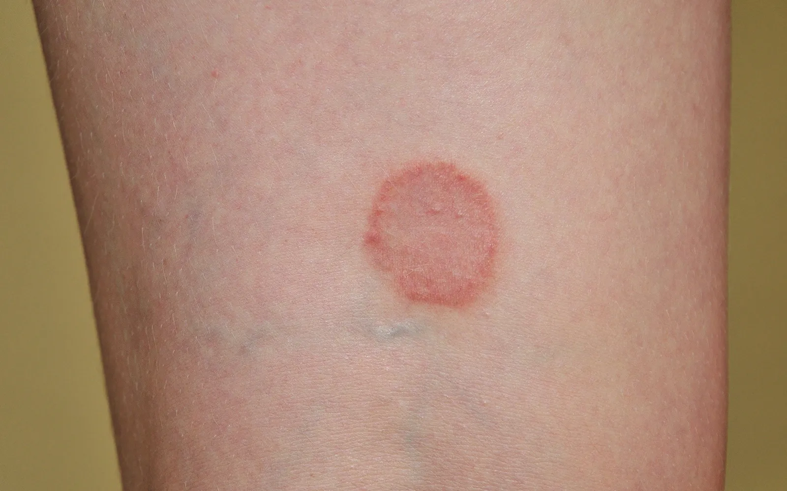 JA_19_Mycoses1 JA_19_Mycoses1