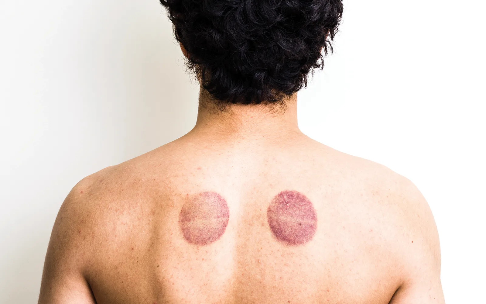 JA_16_CuppingTherapy_Secondary3_1600 JA_16_CuppingTherapy_Secondary3_1600