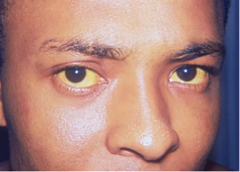 MA_15_Pathology2_jaundice_800px MA_15_Pathology2_jaundice_800px