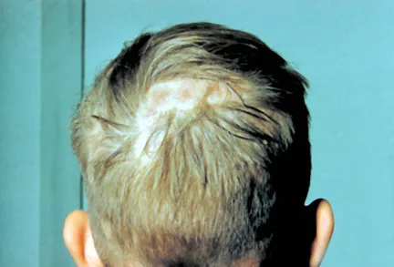 JA_19_Mycoses2 JA_19_Mycoses2