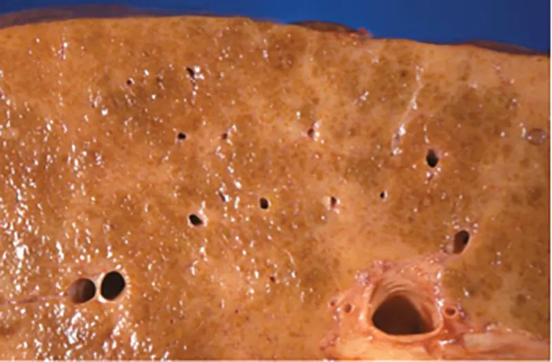 MA_15_Pathology1_liver_800px MA_15_Pathology1_liver_800px
