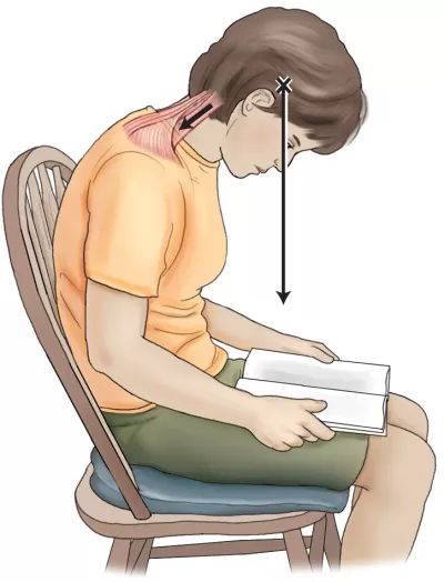 Forward head posture and the counterbalancing contraction of neck musculature in someone sitting bent over in a chair.