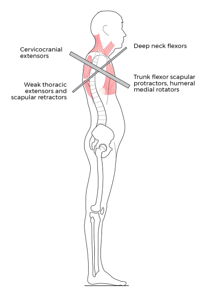 lateral view of upper-crossed syndrome on a skeleton.