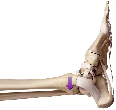  The tibia as it glides posteriorly on the talus. 