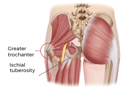 The sciatic nerve pathway in the gluteus/buttocks.