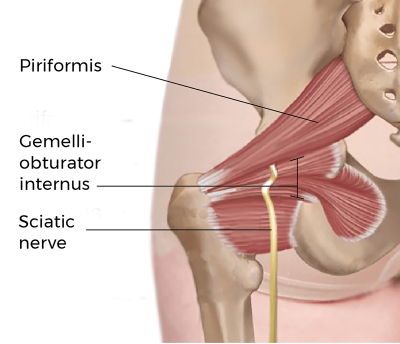 The sciatic nerve kinked between the piriformis and gemelli-obturator internus muscles.