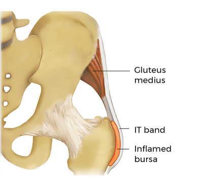 the greater trochanteric bursa and iliotibial (IT) band.