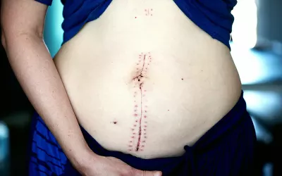 A scar runs vertically in the middle of a person's stomach.