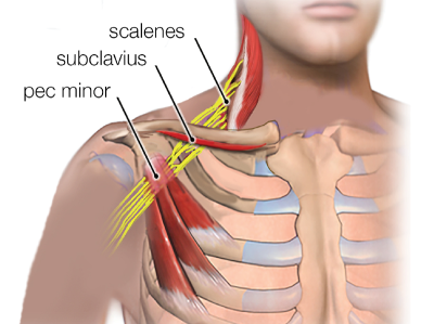 labels showing nerve compression near the subclavius.