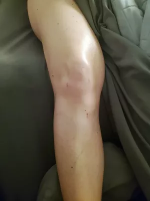 The same client's knee after surgery. 