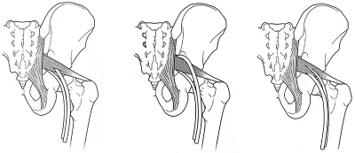 Three variations of the sciatic nerve.