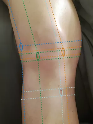 The Omni Scar tissue pattern applied to all scars.