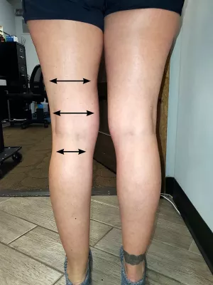 Image indicating scar restriction patterns.