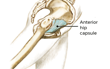 the fibrotic hip capsule. 