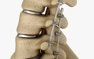 rods placed through a couple vertebrae of the lumbar spine. 