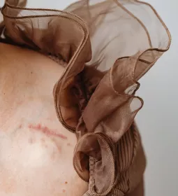 close up of a women's shoulder focused on a scar.