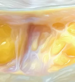 Scar tissue shown from surface to deep.