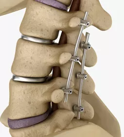 rods placed through a couple vertebrae of the lumbar spine.