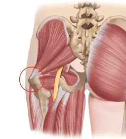 posterior view of the gluteus, showing the sciatic nerve pathway and greater trochanter.