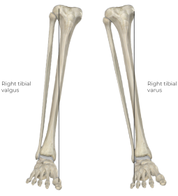 A labeled anatomical diagram of two tibia bones left and right, showing valgus and varus angulations.
