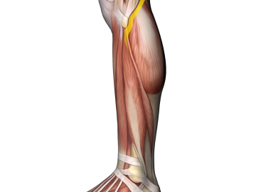 the common fibular nerve and musculature in the upper leg.