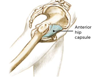 the fibrotic hip capsule. 