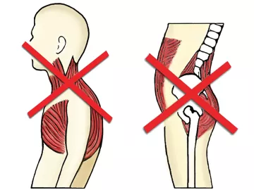 an "x" at the upper body and an "x" at the lower back demonstrating a criss-cross syndrome.