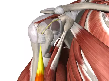 Anatomical display of the biceps tendon attached to the scapula.