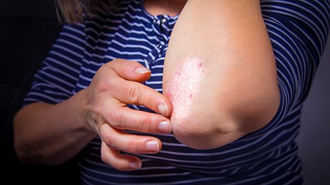 A woman touches her bent elbow to reveal her psoriasis condition.